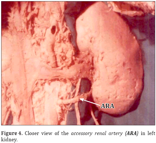 A case report on double ureter and accessory renal artery
