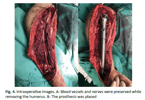 JOTSRR-Intraoperative