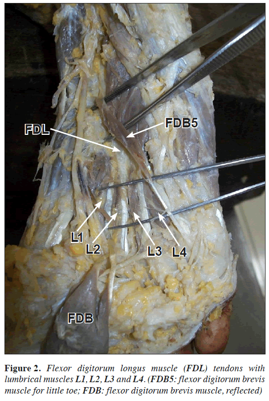 anatomical variation of the flexor digitorum brevis muscle revisited