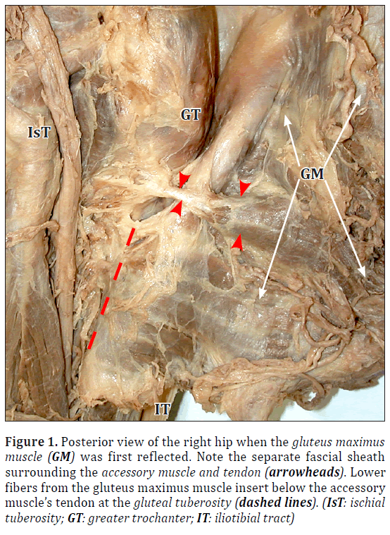 A variant accessory muscle of the gluteus maximus