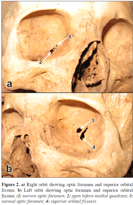 partial closure of right superior orbital fissure with narrow optic superior orbital fissure