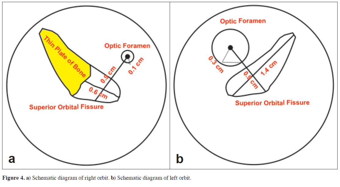 partial closure of right superior orbital fissure with narrow optic superior orbital fissure