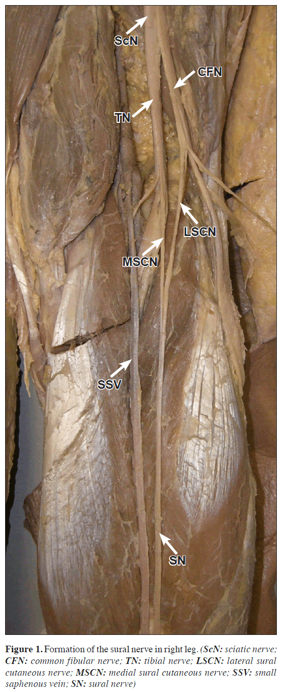 Bilateral variations in the formation of sural nervetibial