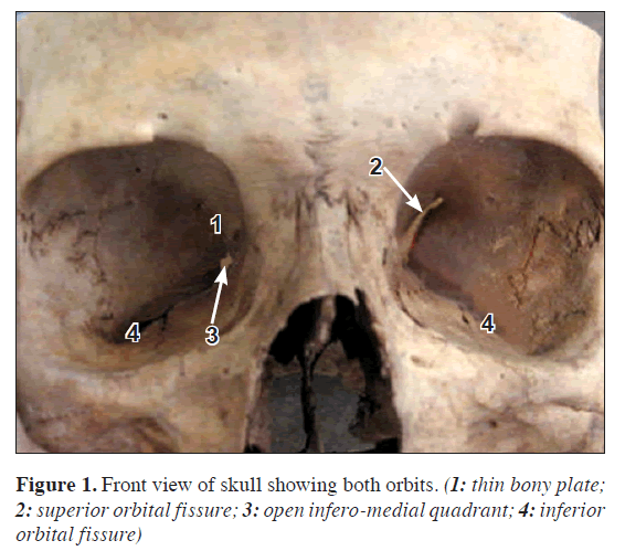 partial closure of right superior orbital fissure with narrow optic superior orbital fissure