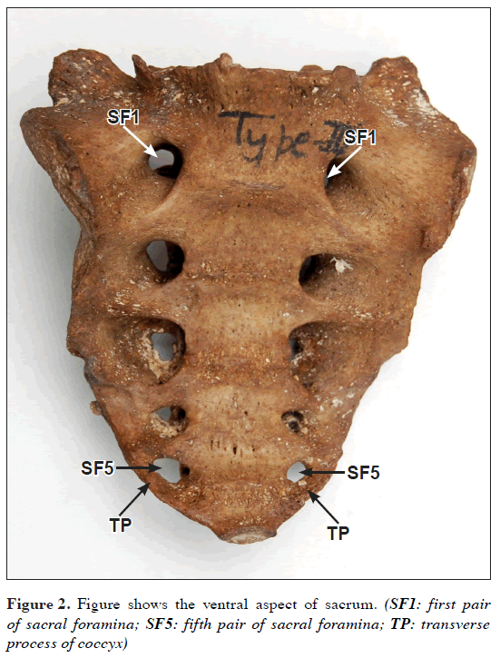 Sacrum with five pairs of sacral foramina
