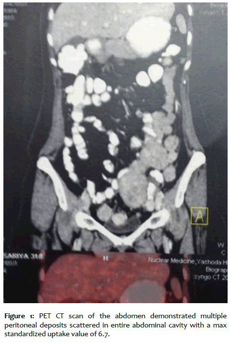 clinical-reproductive-peritoneal-deposits