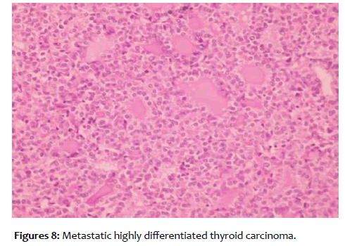 clinical-reproductive-thyroid-carcinoma