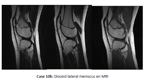 Orthopaedics-Trauma-Discoid