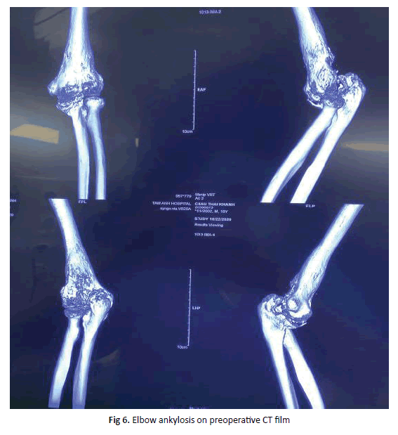 Orthopaedics-Trauma-Elbow-ankylosis