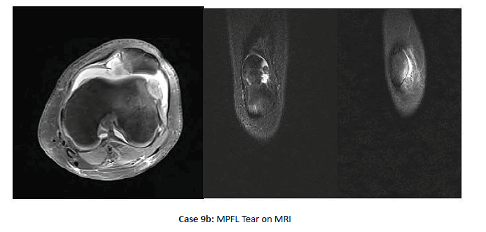 Orthopaedics-Trauma-Tear