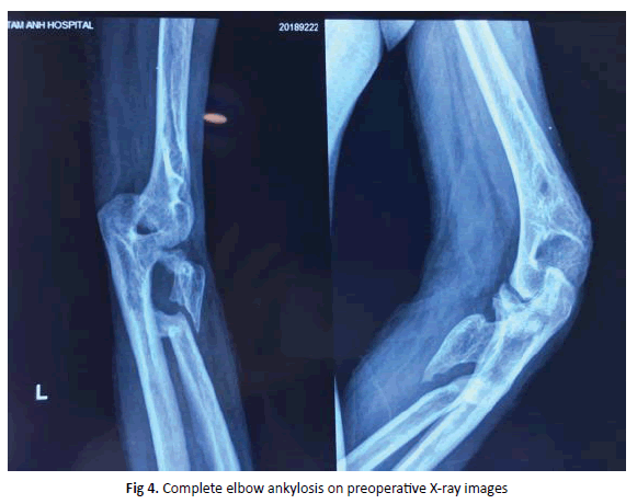 Orthopaedics-Trauma-ankylosis