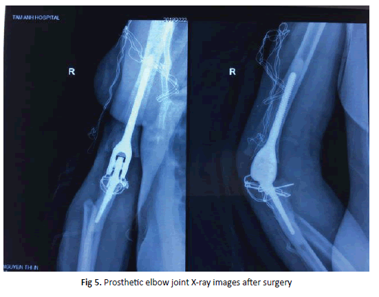 Orthopaedics-Trauma-elbow-joint