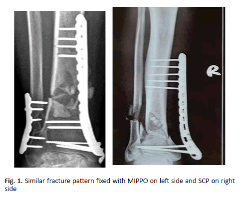 Orthopaedics-Trauma-fracture