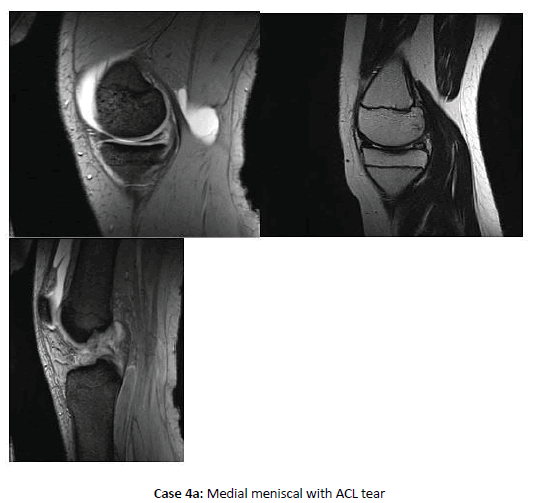 Orthopaedics-Trauma-meniscal