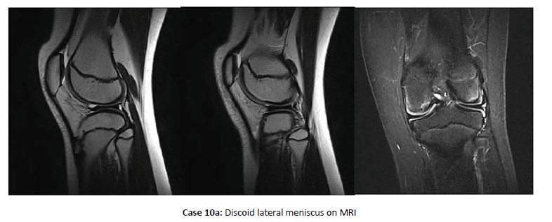 Orthopaedics-Trauma-meniscus