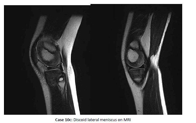 Orthopaedics-Trauma-meniscus