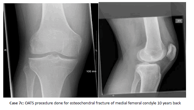 Orthopaedics-Trauma-osteochondral