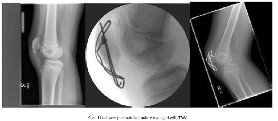 Orthopaedics-Trauma-patella