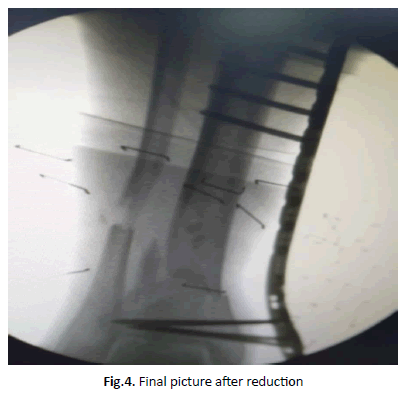 Orthopaedics-Trauma-reduction