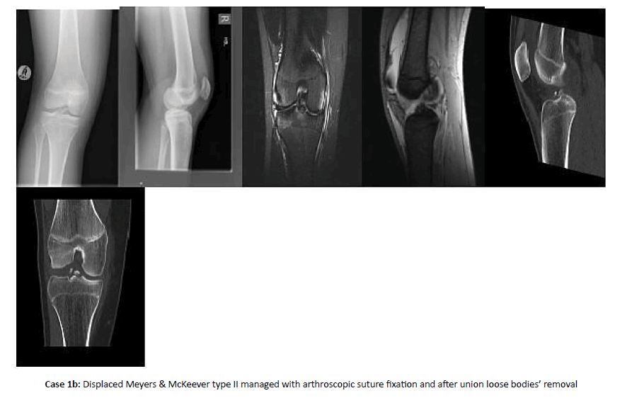 Orthopaedics-Trauma-removal