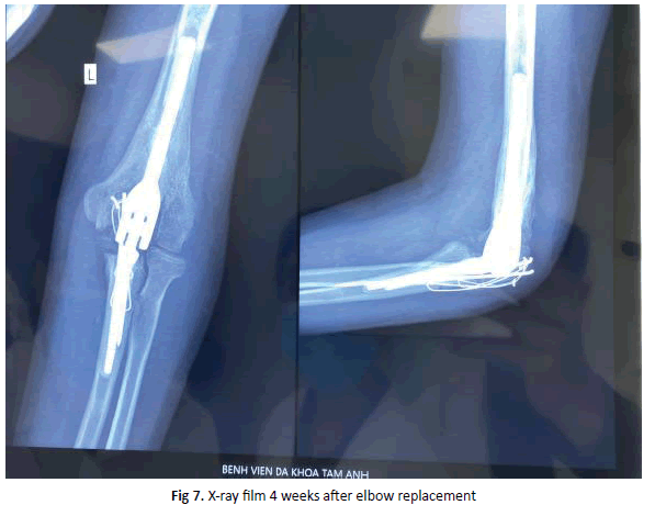Orthopaedics-Trauma-replacement