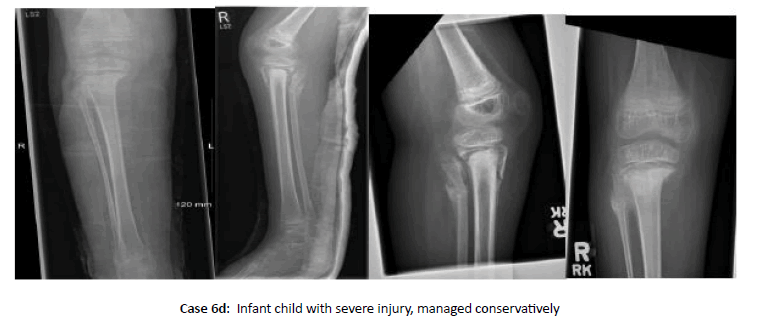 Orthopaedics-Trauma-severe