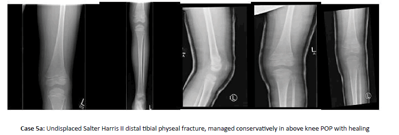 Orthopaedics-Trauma-tibial