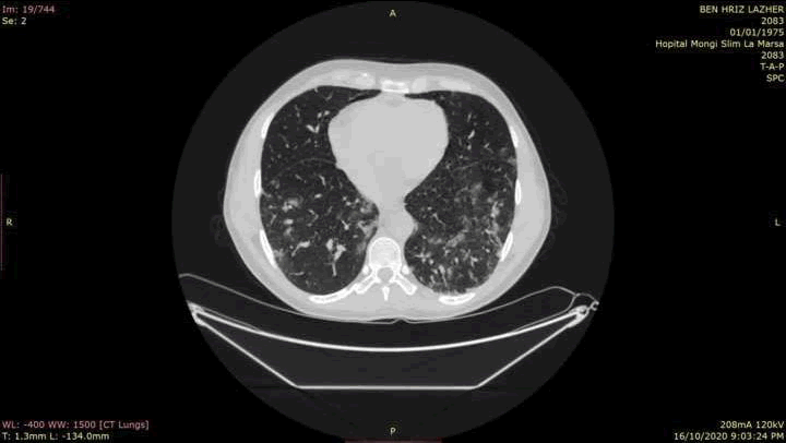 annals-medical-pneumonia