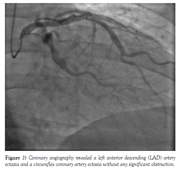 clinical-cardiology-circumflex-coronary