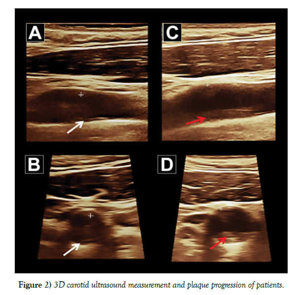 clinical-cardiology-plaque-progression