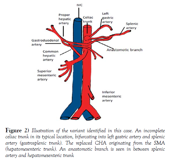 international-journal-anatomical-variations-Illustration