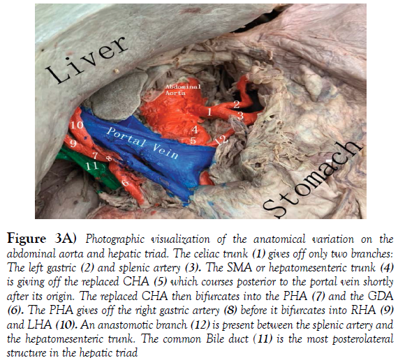 international-journal-anatomical-variations-Photographic