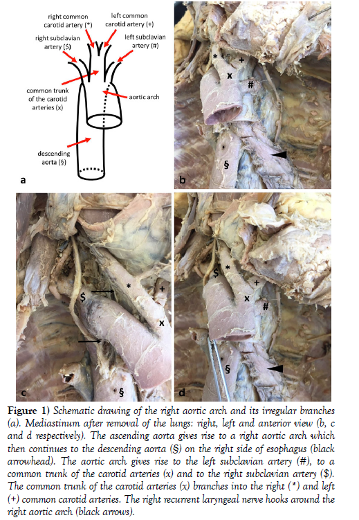 international-journal-anatomical-variations-Schematic