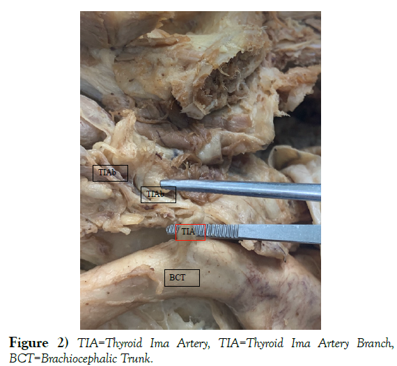 international-journal-anatomical-variations-Thyroid