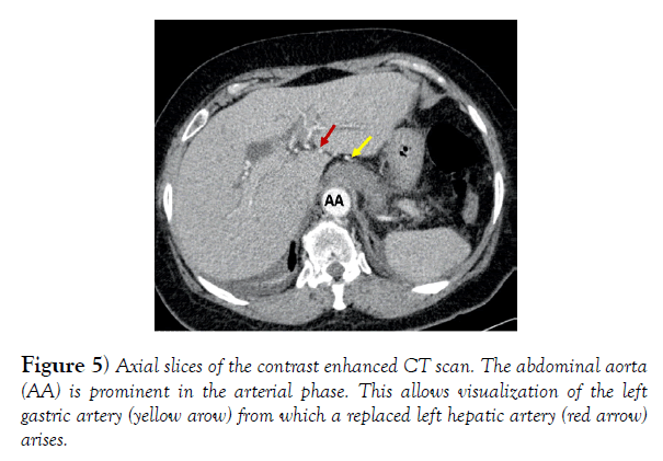 international-journal-anatomical-variations-abdominal-aorta