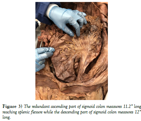 international-journal-anatomical-variations-ascending