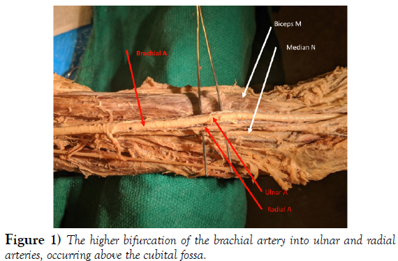 international-journal-anatomical-variations-bifurcation