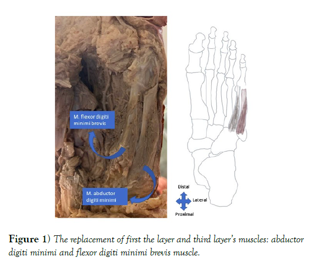 international-journal-anatomical-variations-brevis