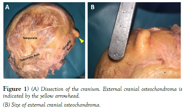 international-journal-anatomical-variations-cranial