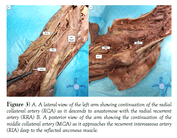 international-journal-anatomical-variations-descends