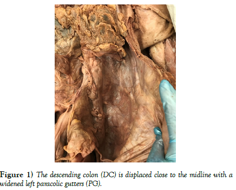 international-journal-anatomical-variations-displaced