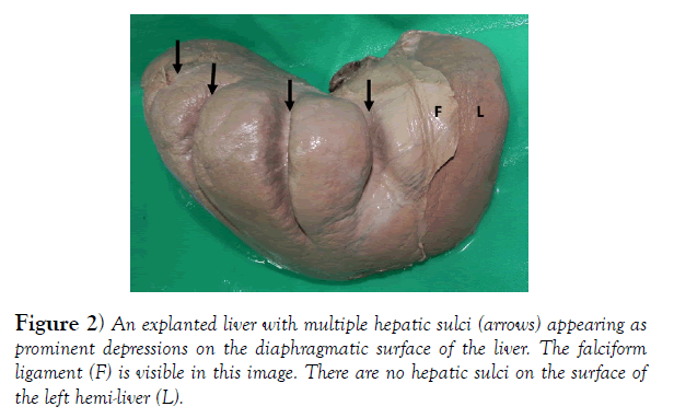 international-journal-anatomical-variations-hepatic-sulci