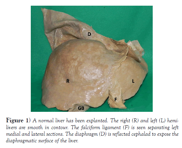 international-journal-anatomical-variations-liver