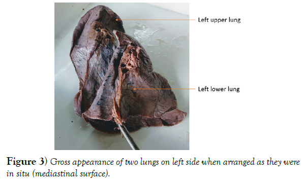 international-journal-anatomical-variations-lungs