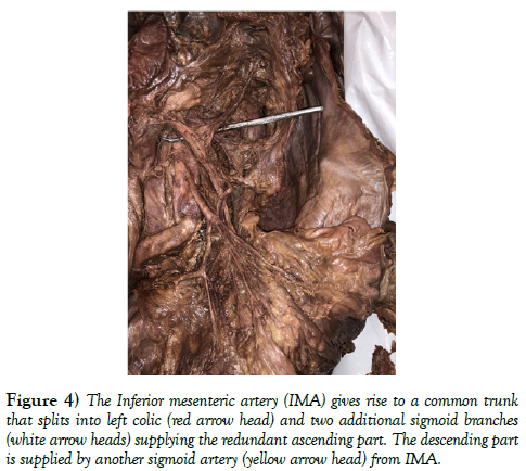 international-journal-anatomical-variations-mesenteric