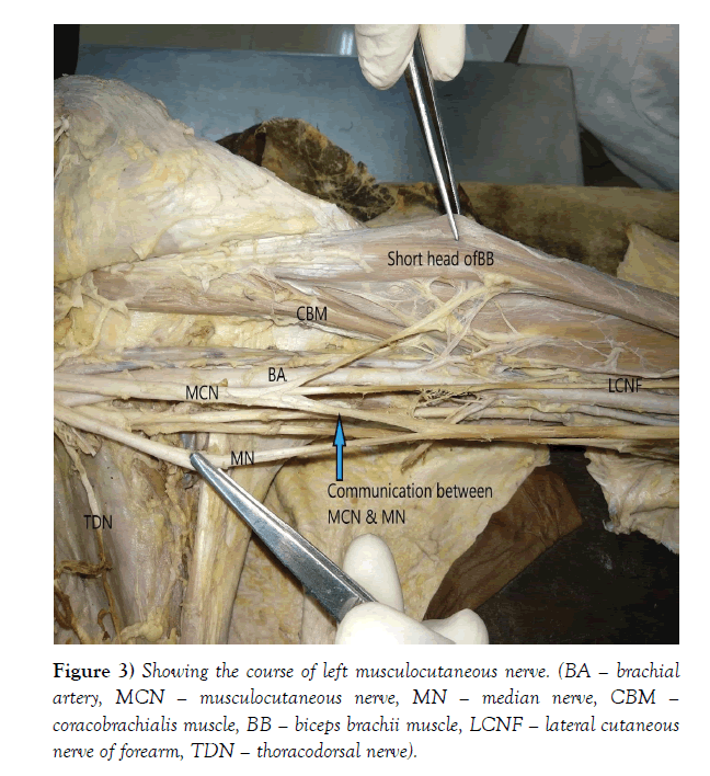international-journal-anatomical-variations-nerve
