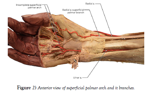 international-journal-anatomical-variations-palmar