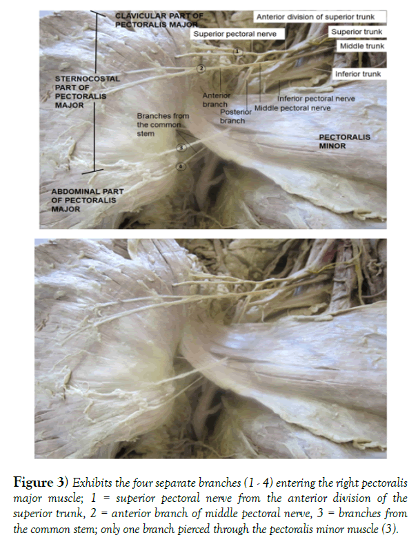 international-journal-anatomical-variations-pectoralis