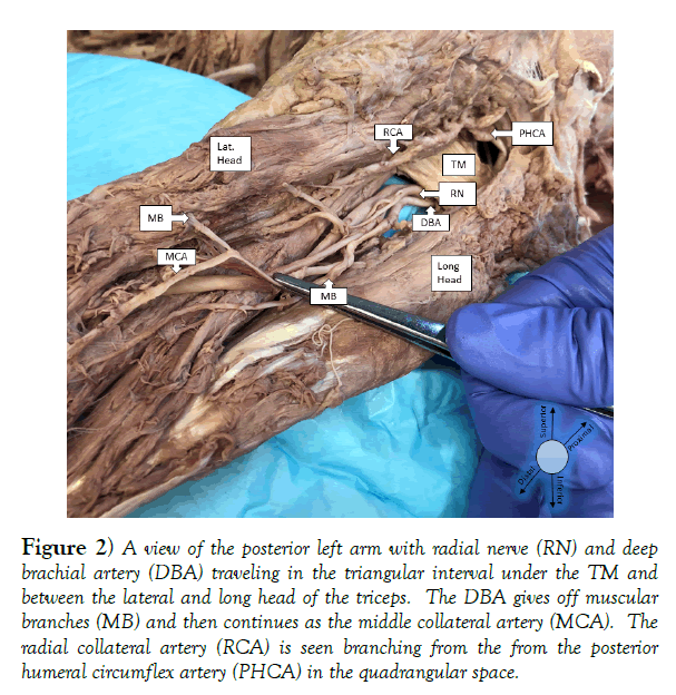 international-journal-anatomical-variations-quadrangular