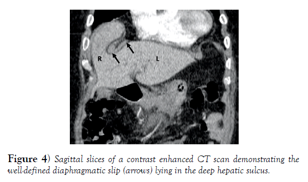 international-journal-anatomical-variations-slip